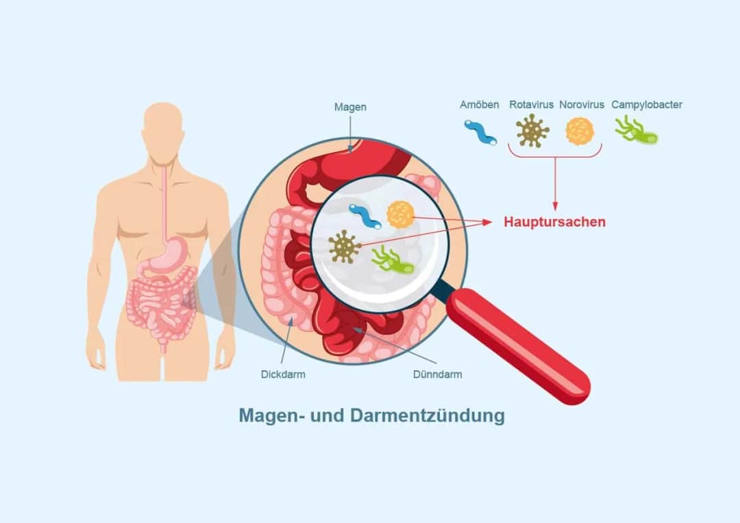 Symptome von Magen Darm: Warnzeichen einer ernsten Infektion erkennen