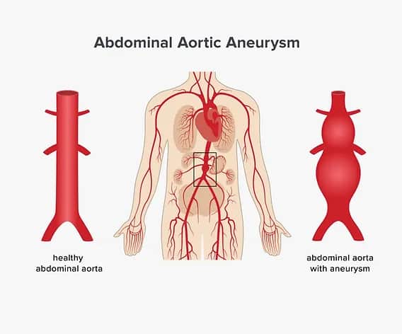 Aneurysma Symptome Bauch: Warnsignale, die Sie nicht ignorieren sollten