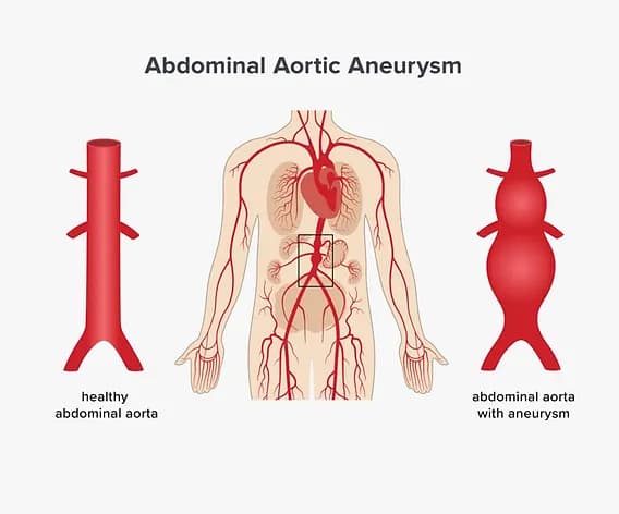 Aneurysma Symptome Bauch: Warnsignale, die Sie nicht ignorieren sollten
