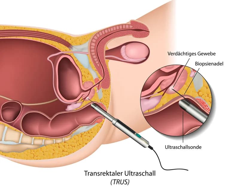 Wichtige Informationen zur Vorsorge Prostatakrebs: Tests und Empfehlungen