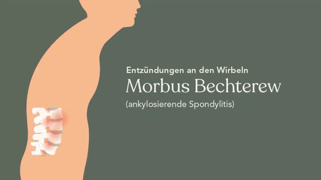 Die entscheidenden Schritte zur Diagnostik von Morbus Bechterew