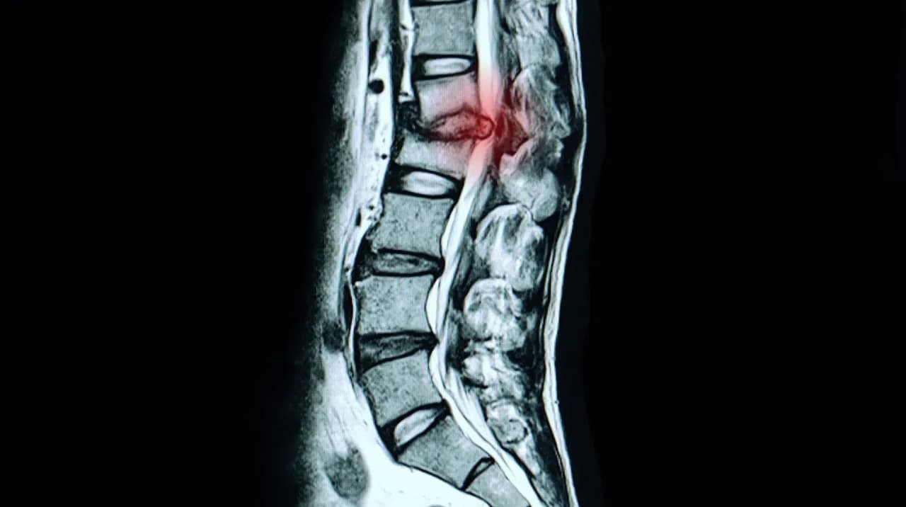 Bandscheibenvorfall LWS Symptome: Warnsignale, die Sie ernst nehmen sollten