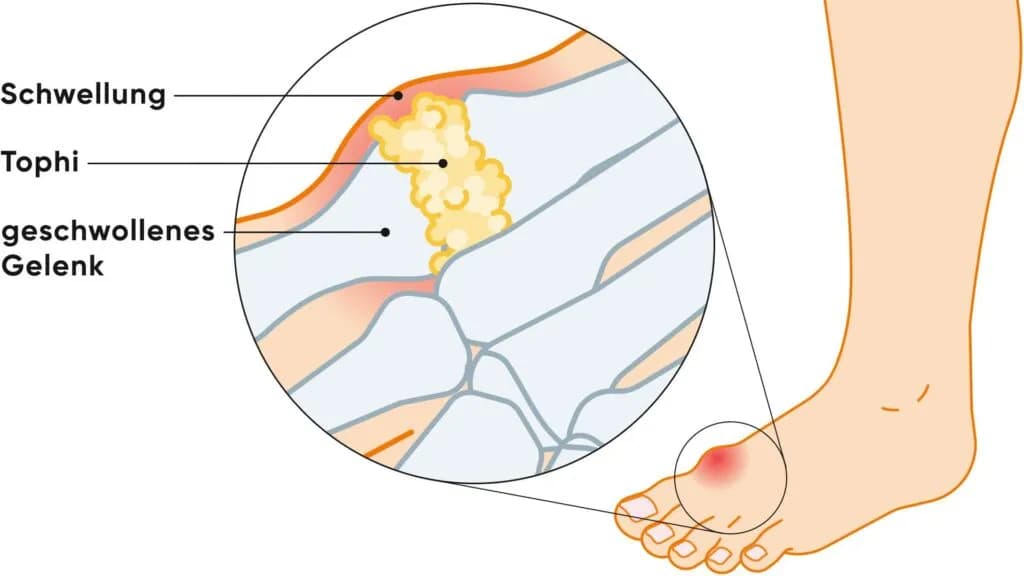 Gicht Symptome Fuß: So erkennen Sie die schmerzhaften Anzeichen