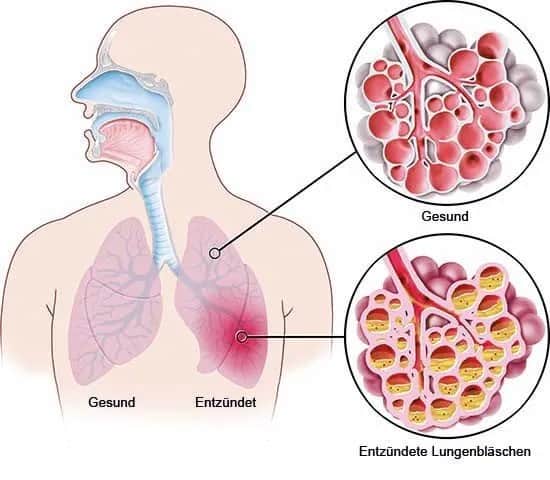 Symptome bei einer Lungenentzündung: So erkennen Sie die Anzeichen