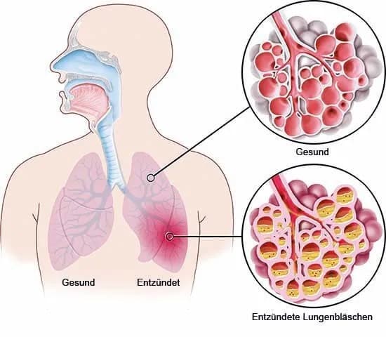 Symptome bei einer Lungenentzündung: So erkennen Sie die Anzeichen
