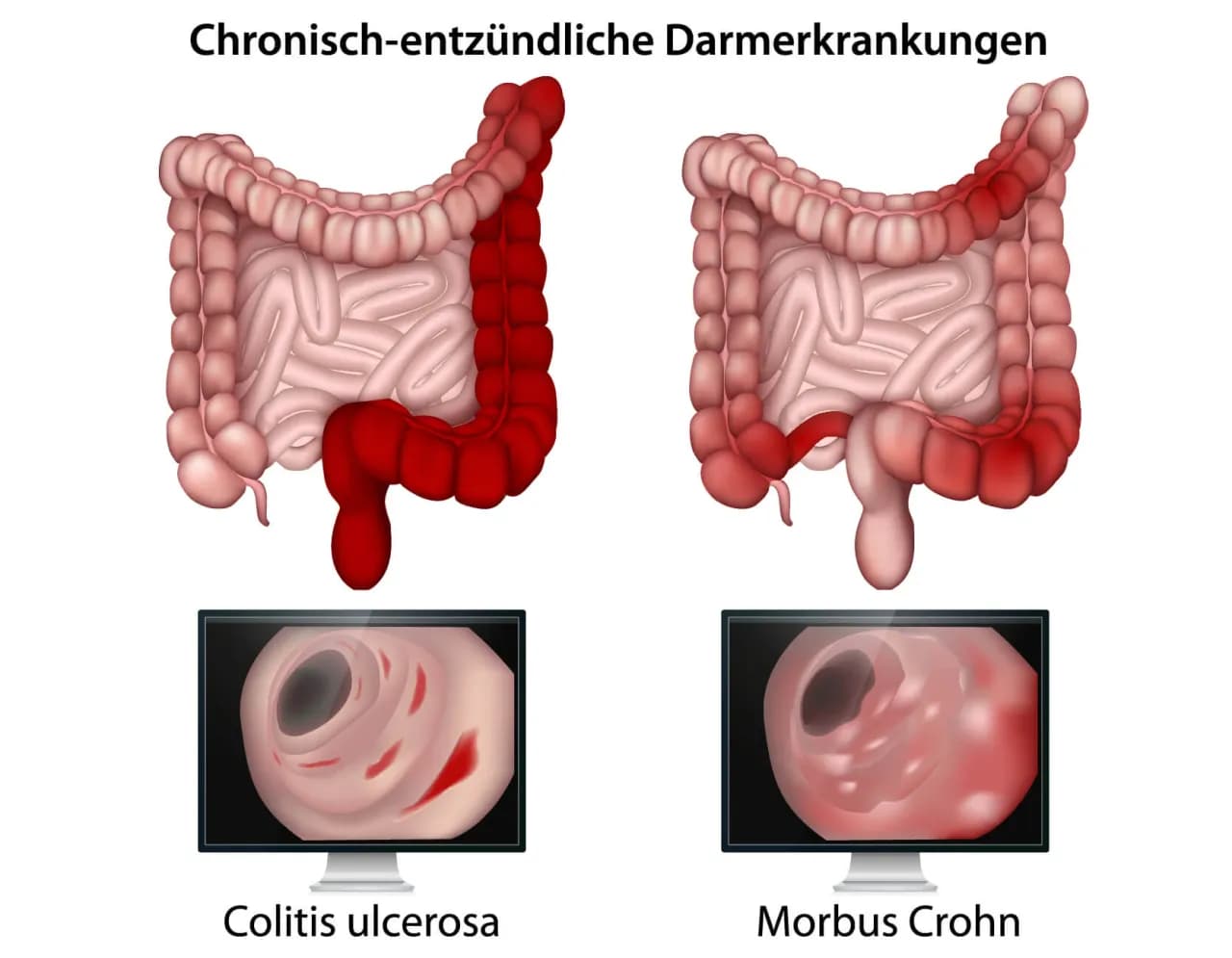 Morbus Crohn Symptome: Erkennen Sie die alarmierenden Anzeichen