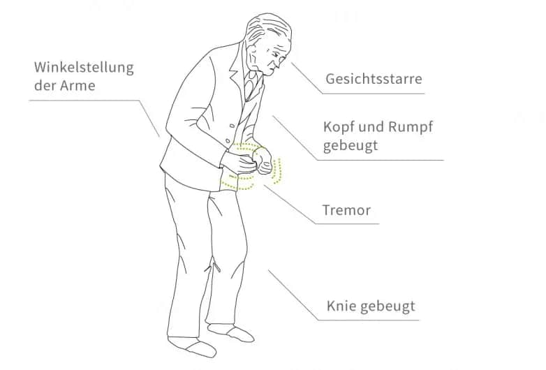 Diagnostik Parkinson Krankheit: So erkennen Sie die Symptome rechtzeitig