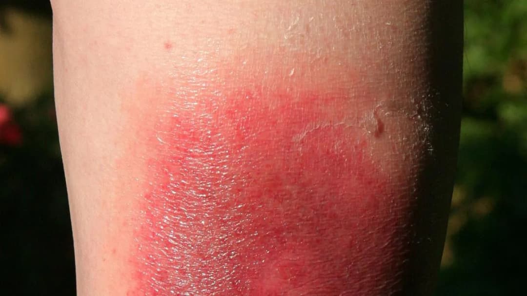 Symptome Borreliose beim Menschen: Warnzeichen, die Sie kennen sollten